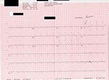 An ECG showing a fusion beat.