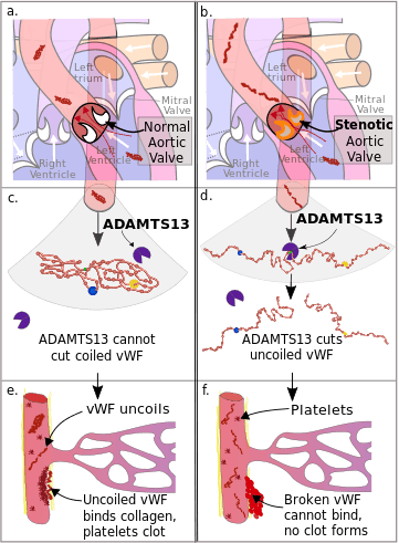 Diagram of the pathophysiology of Heyde's syndrome