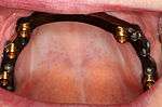 Bar overdenture