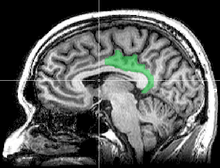 Sagittal MRI slice with highlighting indicating location of the posterior cingulate.