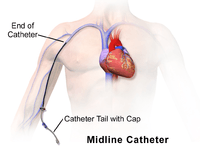 Midline Catheter