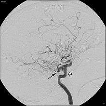 Persistent trigeminal artery